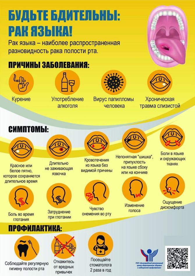 Рак языка: симптомы, диагностика, лечение, стадии и профилактика онкологии